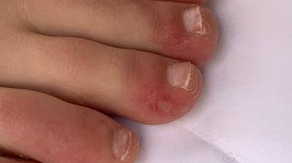 Coronavirus: ‘Covid toe’ and other rashes puzzle doctors