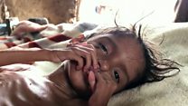 Yemen crisis: Five years of hunger, five years of war