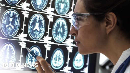 Alzheimer’s drug lecanemab hailed as momentous breakthrough